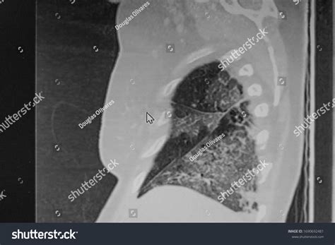 Chest Ct Scan Novel Coronavirus Covid19 Stock Photo 1690692481 ...