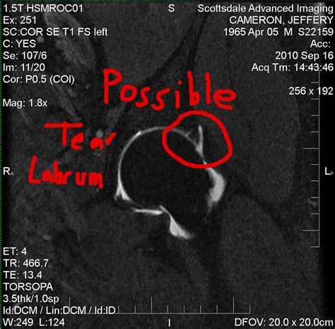 MRI SHOWING POSSIBLE TEAR IN LABRUM - Jeff Cameron