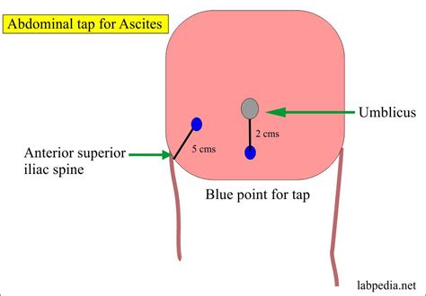 Fluid Analysis – Part 4 – Ascitic fluid, Peritoneal tap, abdominal paracentesis, abdominal tap ...