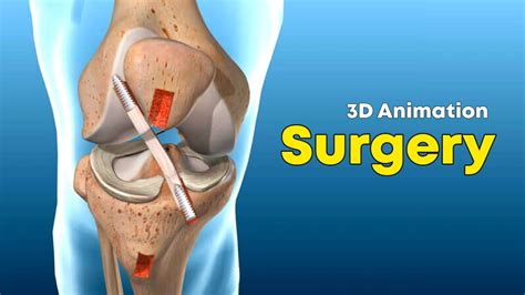 ACL (Surgery)- Knee Ligament Surgery ACL Repair - 3D Animation - YouTube