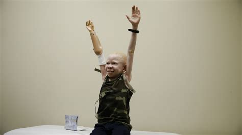 Four young albino children return to U.S. for new prosthetic limbs ...