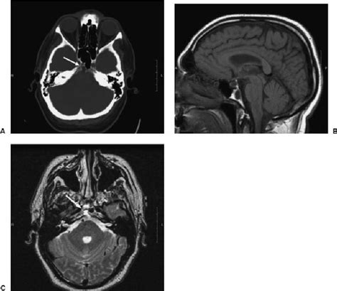 (A) Axial CT (bone window) shows a focus of bone loss in the clivus ...