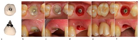 JCM | Free Full-Text | Immediate Implant and Customized Healing Abutment for a Periodontally ...