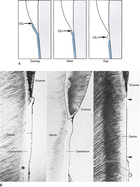 14. Periodontium: Cementum, Alveolar Bone, and Periodontal Ligament ...