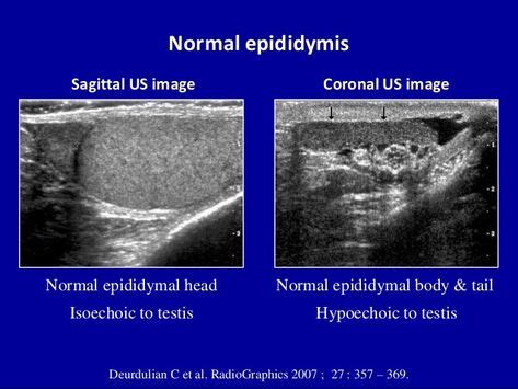 usg testis