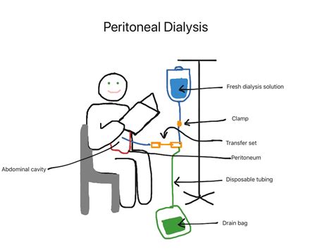 Peritoneal dialysis | Science, Human-body, Medical, Nursing ...