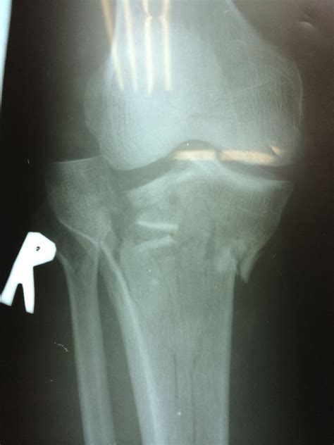 Understanding Bone Fracture X-Rays