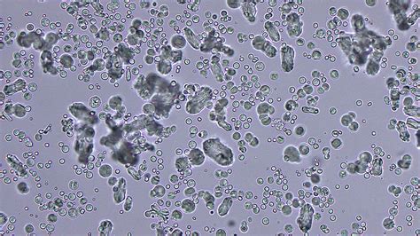 calcium carbonate Archives | eClinpath