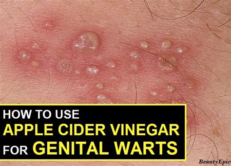 How to Use Apple Cider Vinegar for Genital Warts?