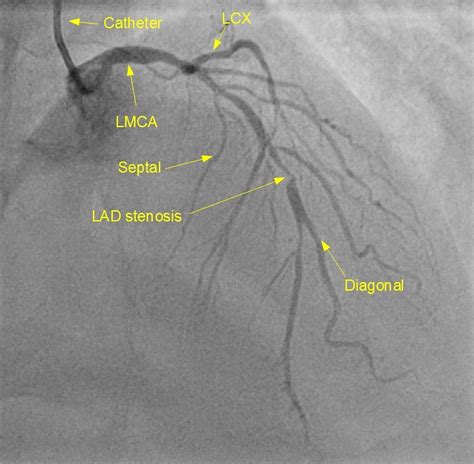 LAD Stenosis – Left coronary angiogram – All About Cardiovascular System and Disorders