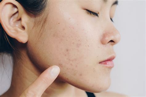 How to Avoid and Treat Unsightly Acne Scars | Banner Health