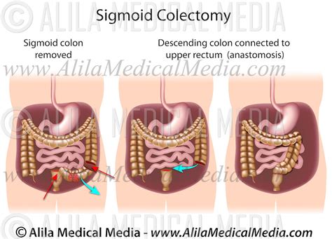 Sigmoid colectomy | Alila Medical Images