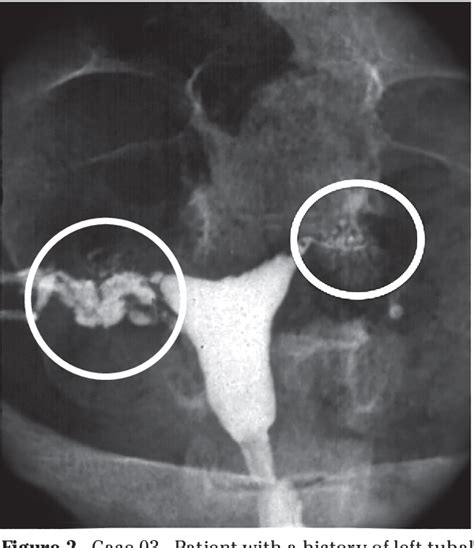 [PDF] Isthmian nodosa salpingitis: histero-salpingography diagnosis of an infertility cause ...