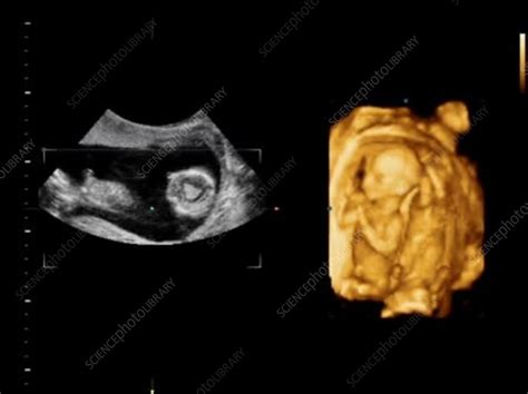 16-week-old twin foetuses, ultrasound scans - Stock Video Clip - K007/0317 - Science Photo Library