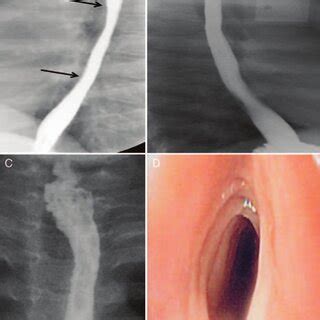 (PDF) Savary Dilation Is Safe and Effective Treatment for Esophageal Narrowing Related to ...