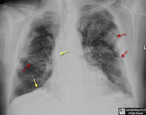 Learning Radiology - Asbestos-Related Pleural Disease, asbestosis