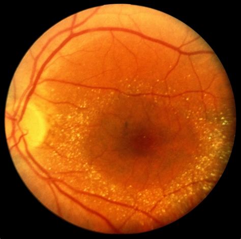 Crystalline Retinopathy - Retina Image Bank