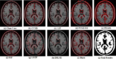 The results on the brain image using different ACMs. (a)–(i) The red... | Download Scientific ...