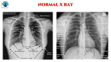 Abnormal Chest X-ray Interpretation