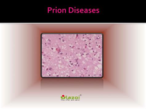 PPT - Prion Disease: Causes, Symptoms, Daignosis, Prevention and ...