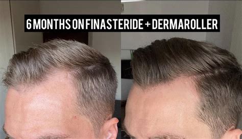 Do you see any progress? 6 months on Finasteride (Propecia 1mg/day ...