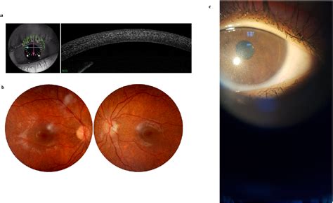 Figure 1 from Ophthalmic and Genetics Profiles of Cystinosis in Tunisian Patients | Semantic Scholar