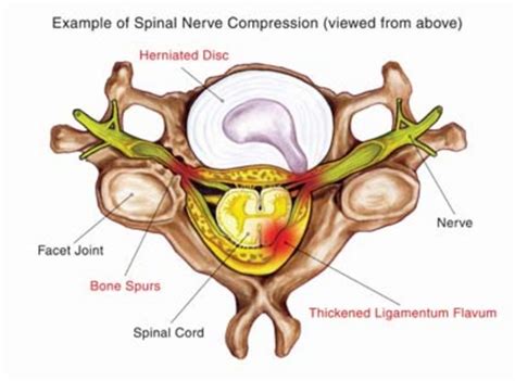 Ligamentum flavum