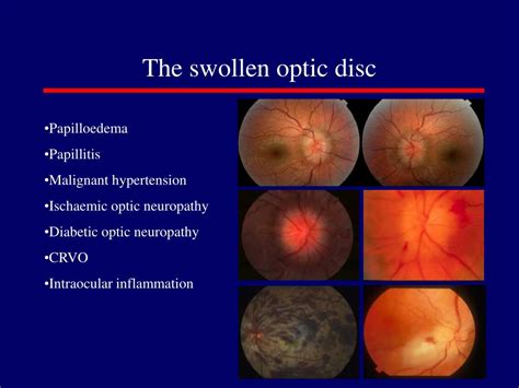 PPT - NEURO-OPHTHALMOLOGY PowerPoint Presentation, free download - ID:707507