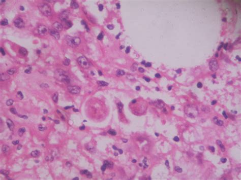 Entamoeba histolytica – Histopathology.guru