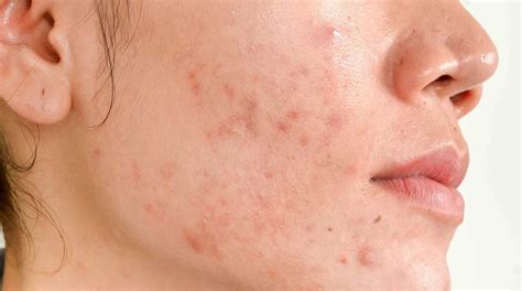 What Causes Hormonal Acne? | Hero Cosmetics