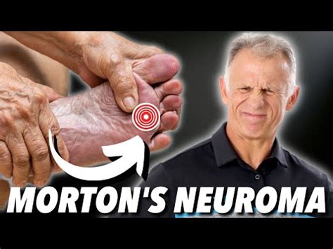 Strengthening Exercises For Morton's Neuroma