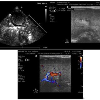 Ultrasound images of the patients on day 2 of life (B) umbilical vein ...