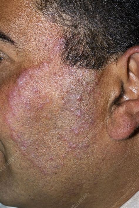 Tinea fungal infection on the face - Stock Image - C010/3378 - Science Photo Library