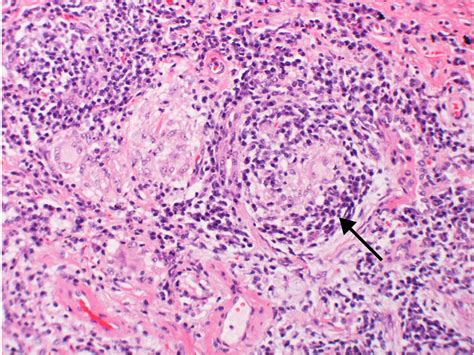 Interstitial Lung Disease Histology