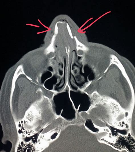 #Face #CT #scan shows #fractures of the #nasal #bones in a #patient who ...