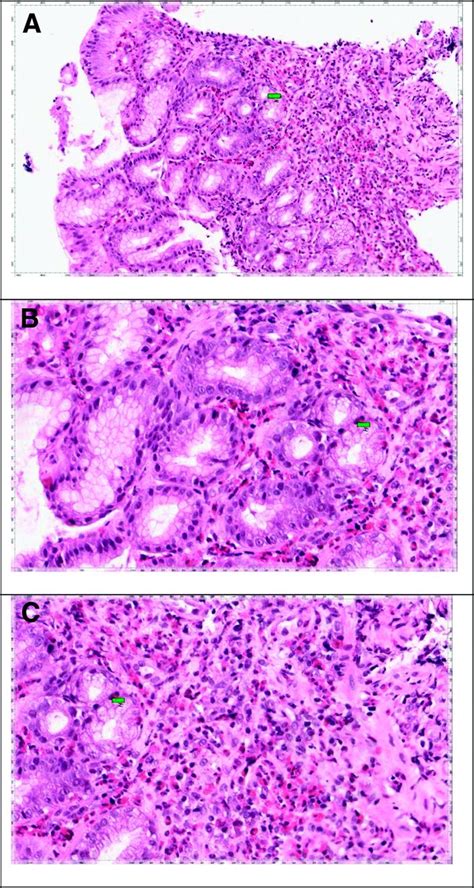 Eosinophilic Gastroenteritis Presenting with Severe Anemia and Near ...