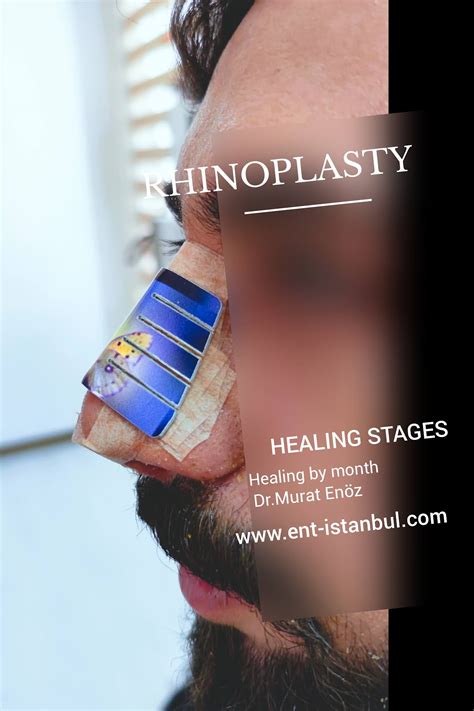 Rhinoplasty Recovery Guide 👃 - 30 - Total Healing Time After Rhinoplasty