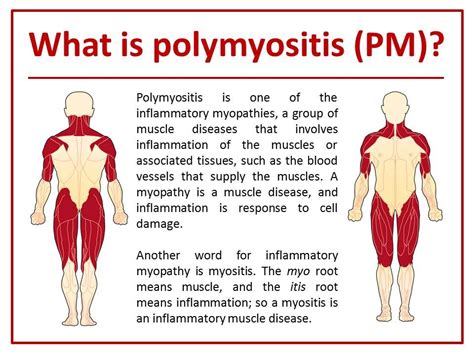 .what is polymyositis | Polymyositis | Pinterest | Autoimmune disease ...