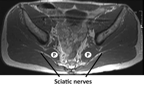 Imaging the Back and Sciatic Nerve | SpringerLink