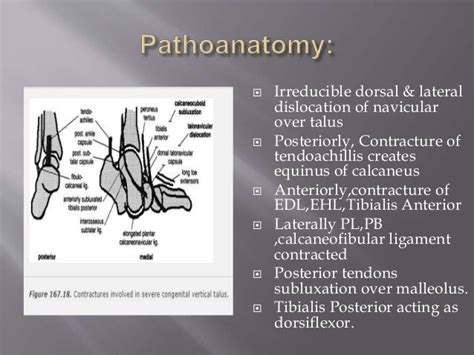 Congenital vertical talus