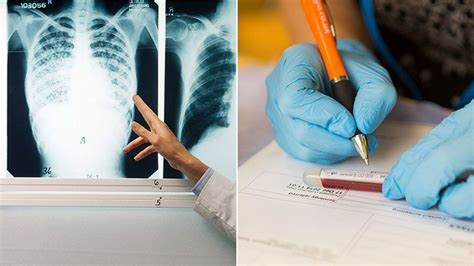 How To Detect Tuberculosis - Netwhile Spmsoalan