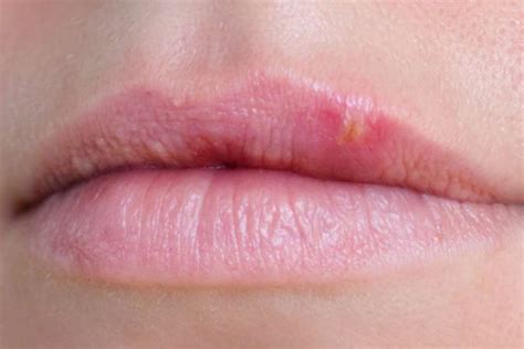 Don't Ignore These 10 Health Warning Signs Your Lips are Telling You ...