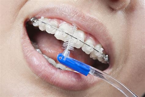 Brushing your teeth with braces — Stock Photo © m.iskandarov #30960513