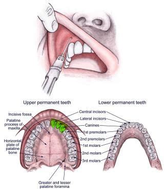 Maxillary Nerve Block High Tuberosity Approach