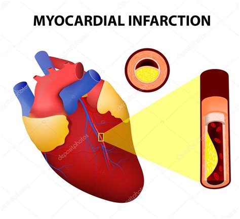 Myocardial infarction — Stock Vector © edesignua #53074581