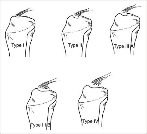 Tibial Spine Avulsion Fractures: Current Concepts and Technical Note on ...