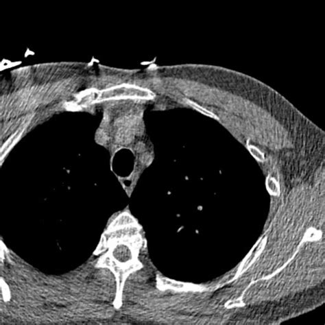 Thorax Ct Scan