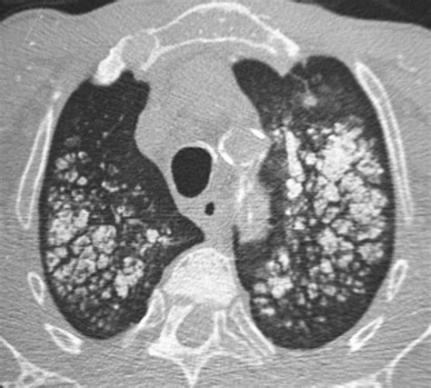 Axial CT scan demonstrating multiple bilateral centrilobular calcified... | Download Scientific ...