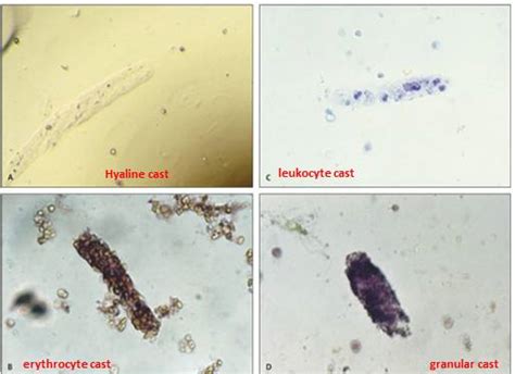 Casts in Urine | Medical Laboratories