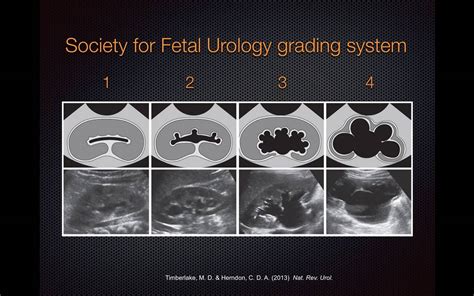 Grading Hydronephrosis on Bedside Ultrasound - YouTube